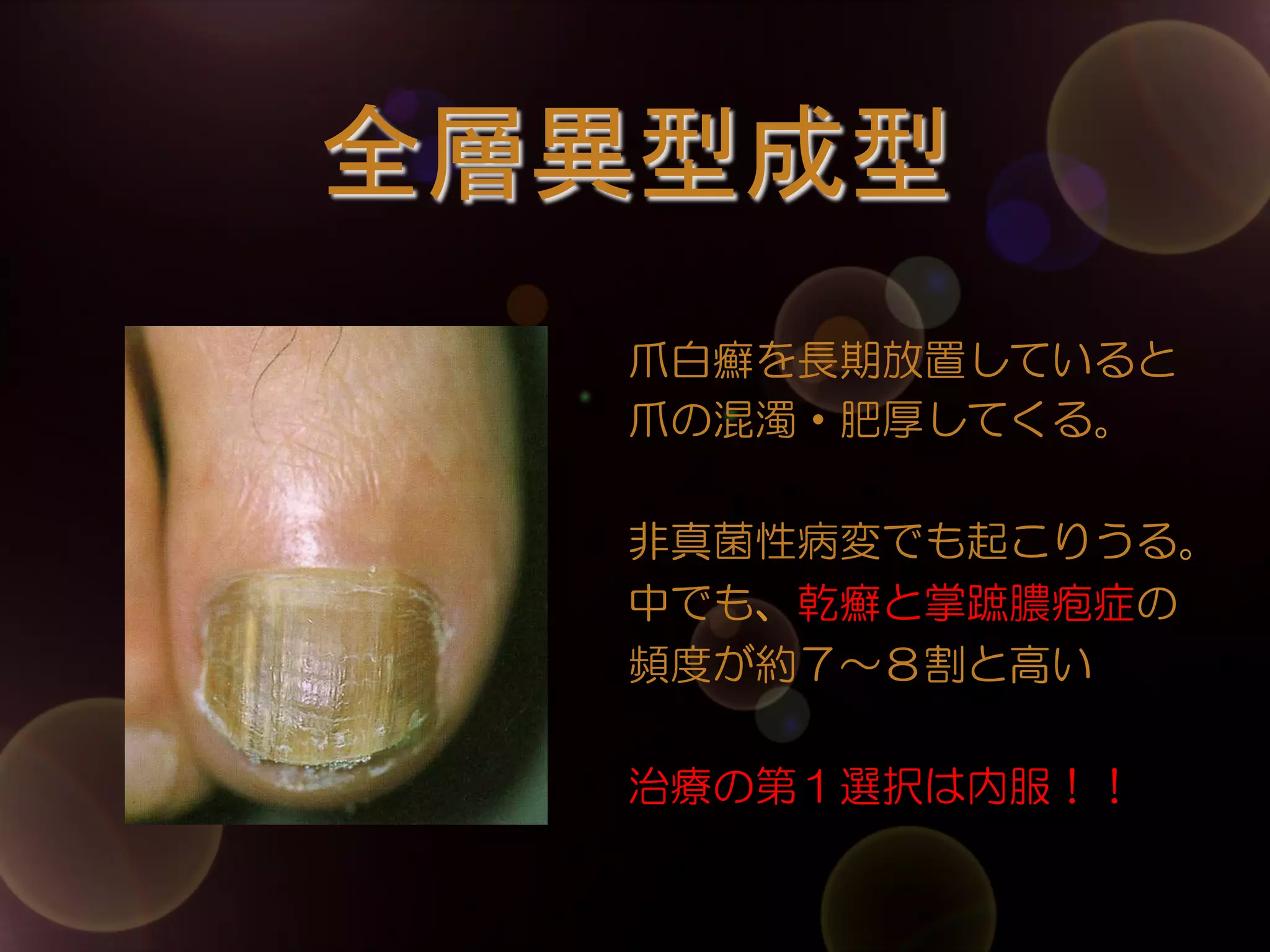 全層異型成型	
爪白癬を長期放置していると
爪の混濁・肥厚してくる。
非真菌性病変でも起こりうる。
中でも、乾癬と掌蹠膿疱症の
頻度が約７～８割と高い
治療の第１選択は内服！！

 