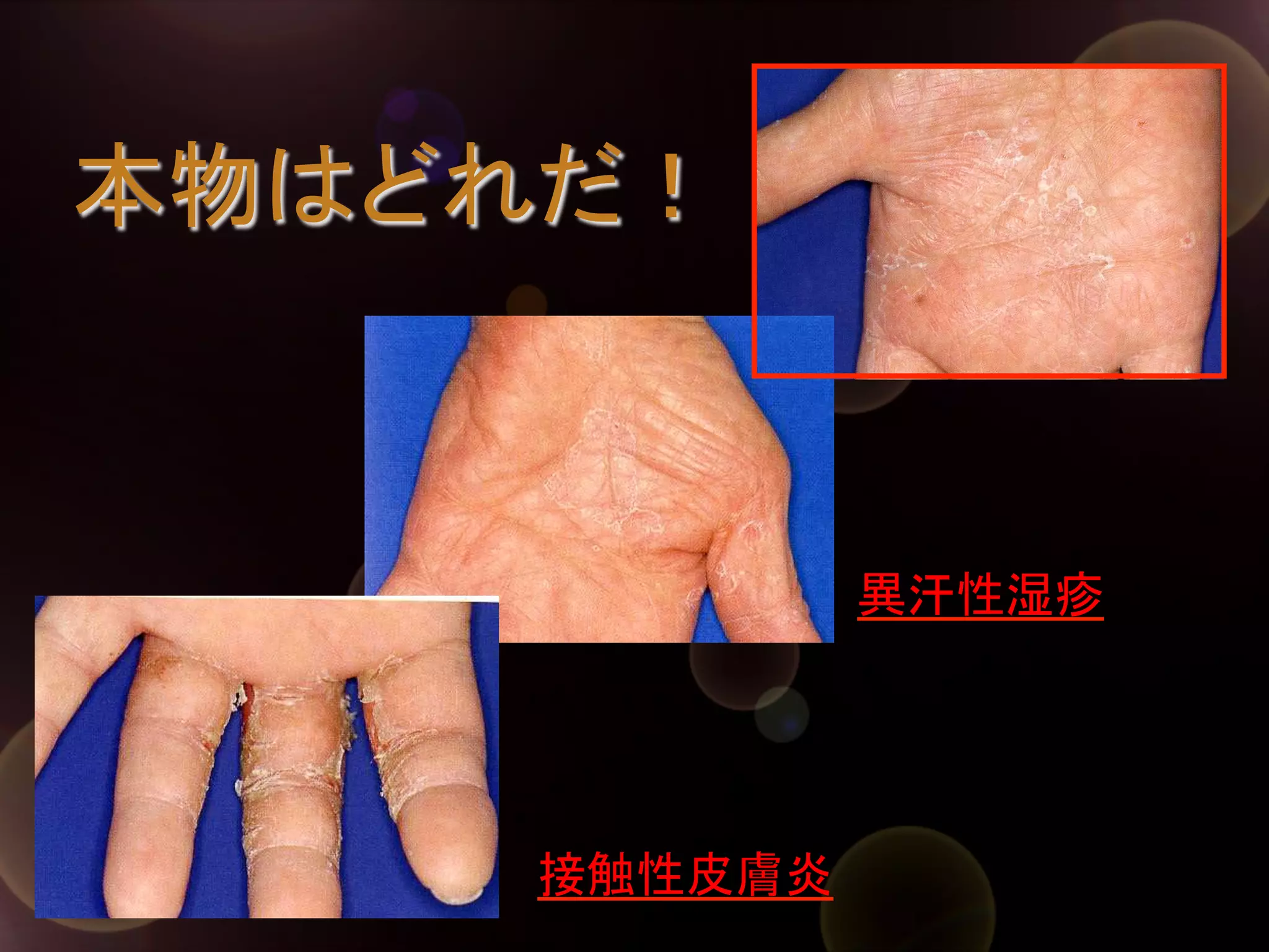 本物はどれだ！	

異汗性湿疹	

接触性皮膚炎	

 