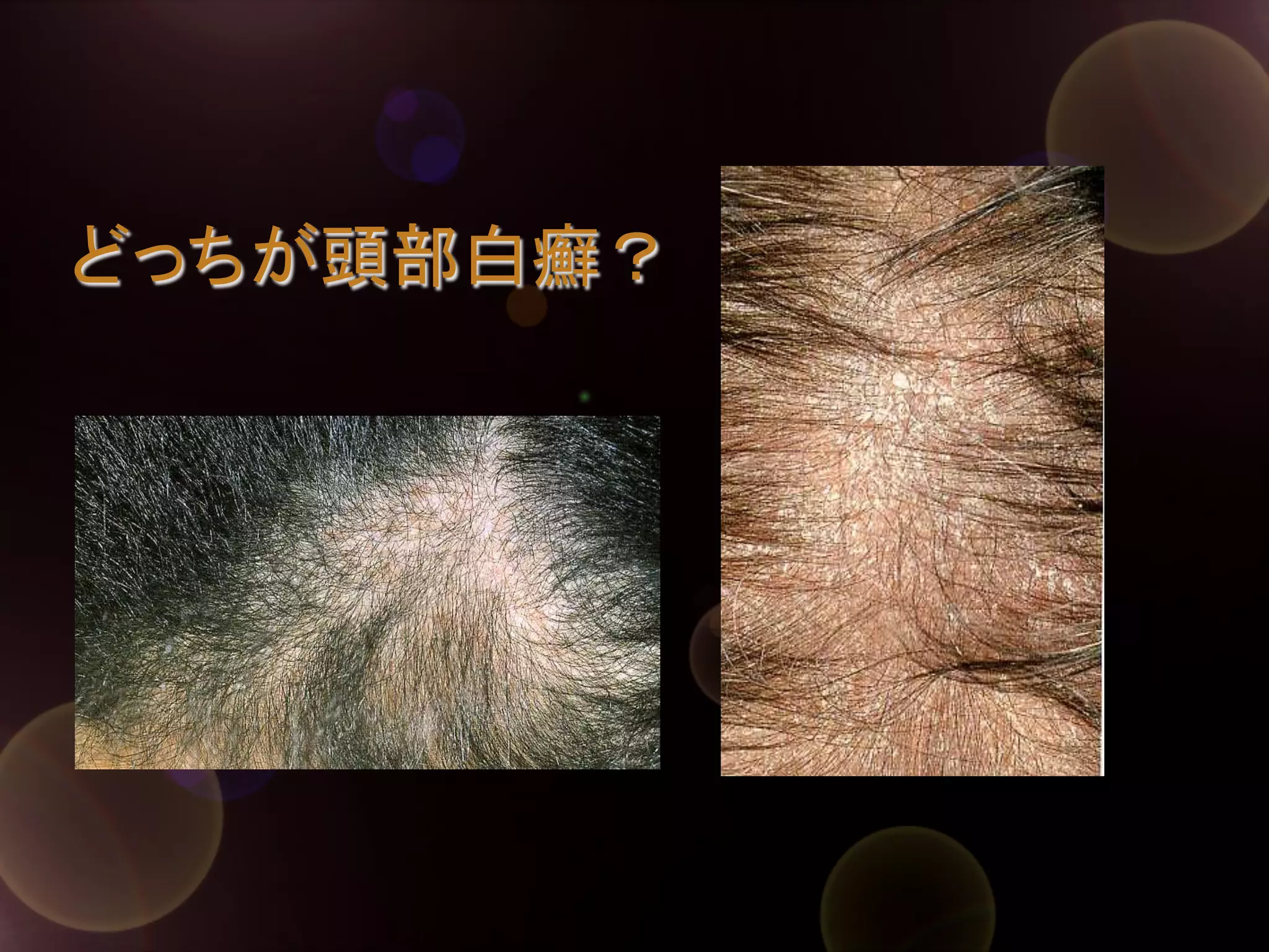 どっちが頭部白癬？	

 