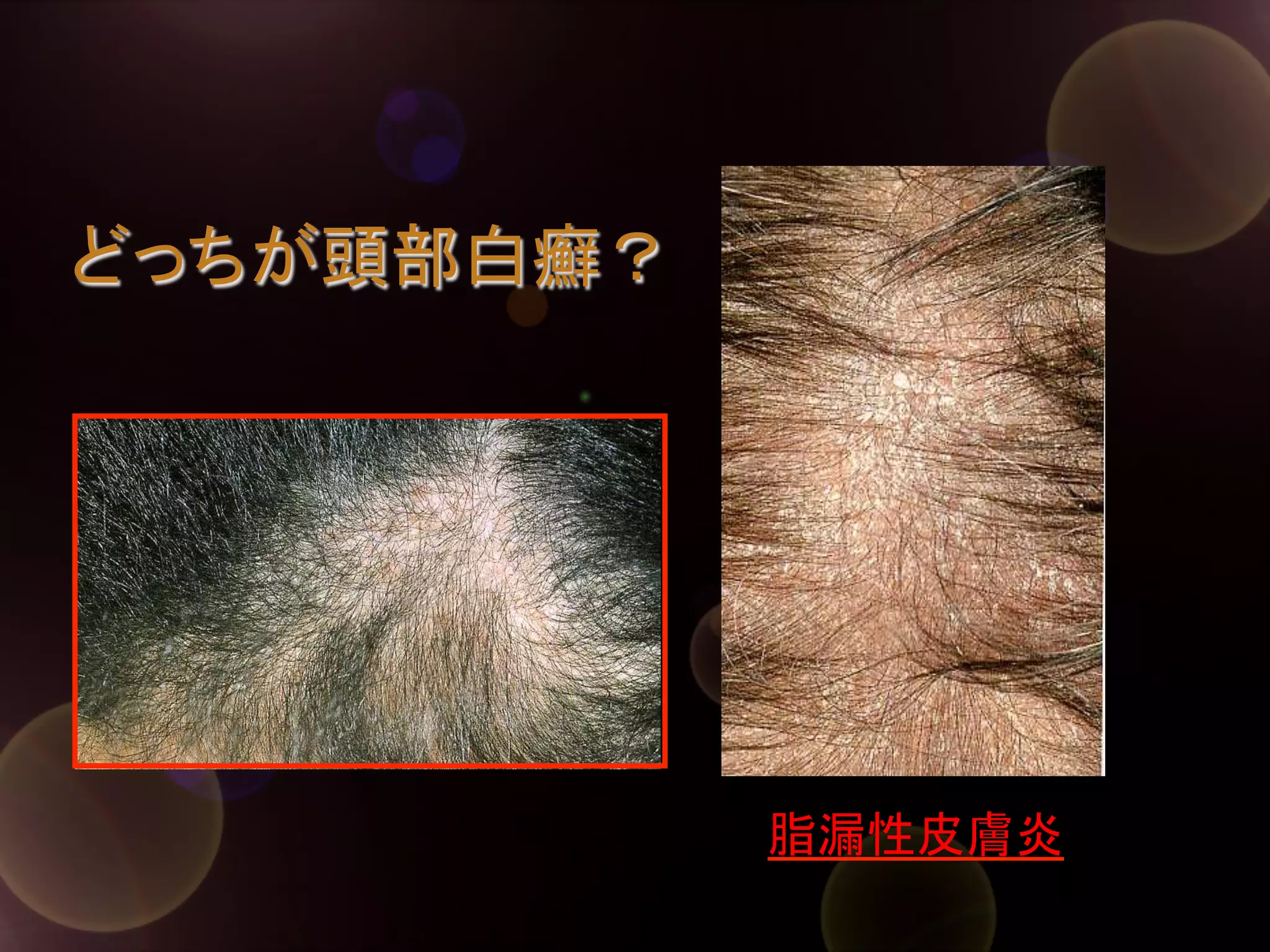 どっちが頭部白癬？	

脂漏性皮膚炎	

 