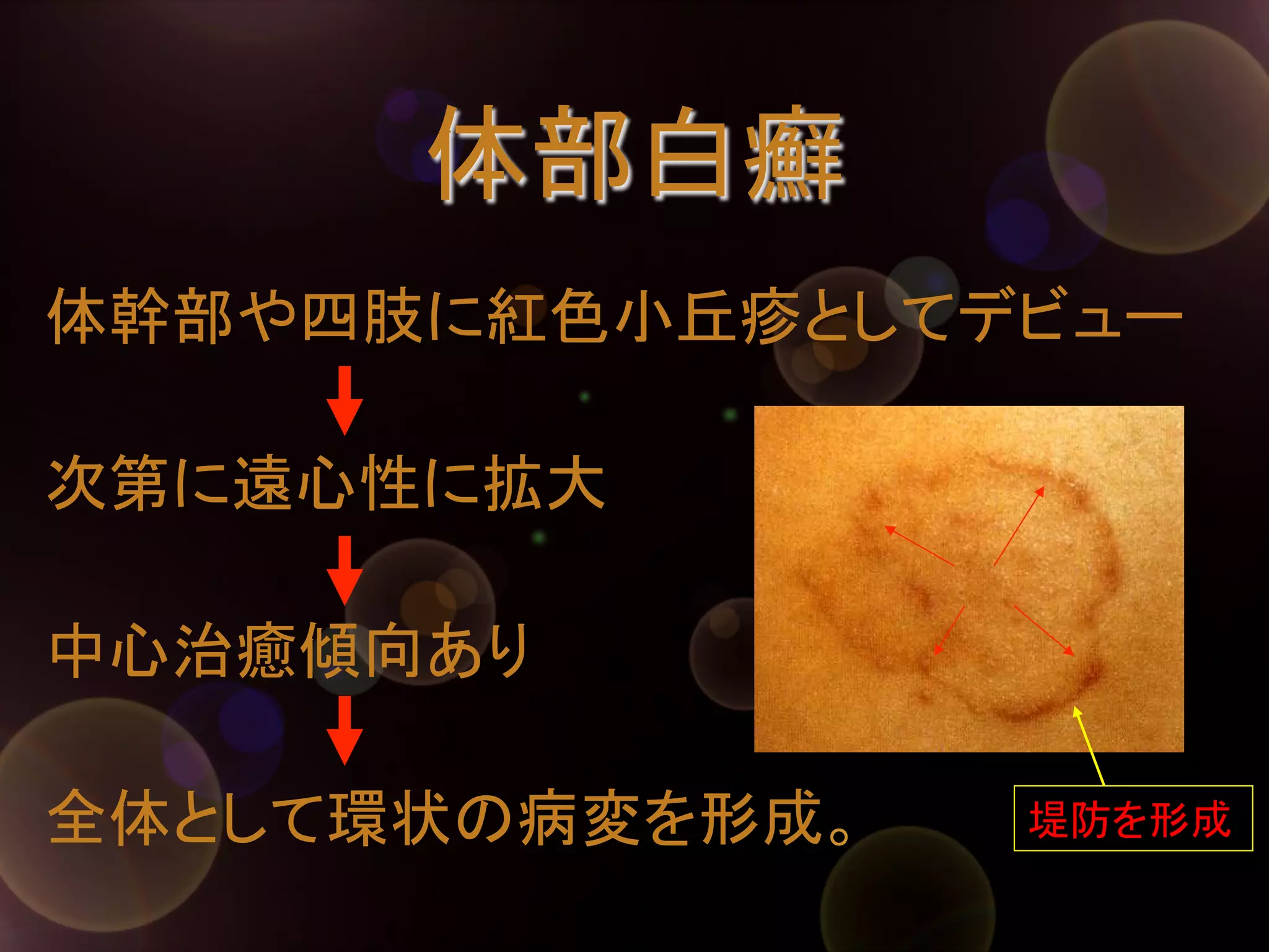体部白癬	
体幹部や四肢に紅色小丘疹としてデビュー
次第に遠心性に拡大
中心治癒傾向あり
全体として環状の病変を形成。	

堤防を形成	

 