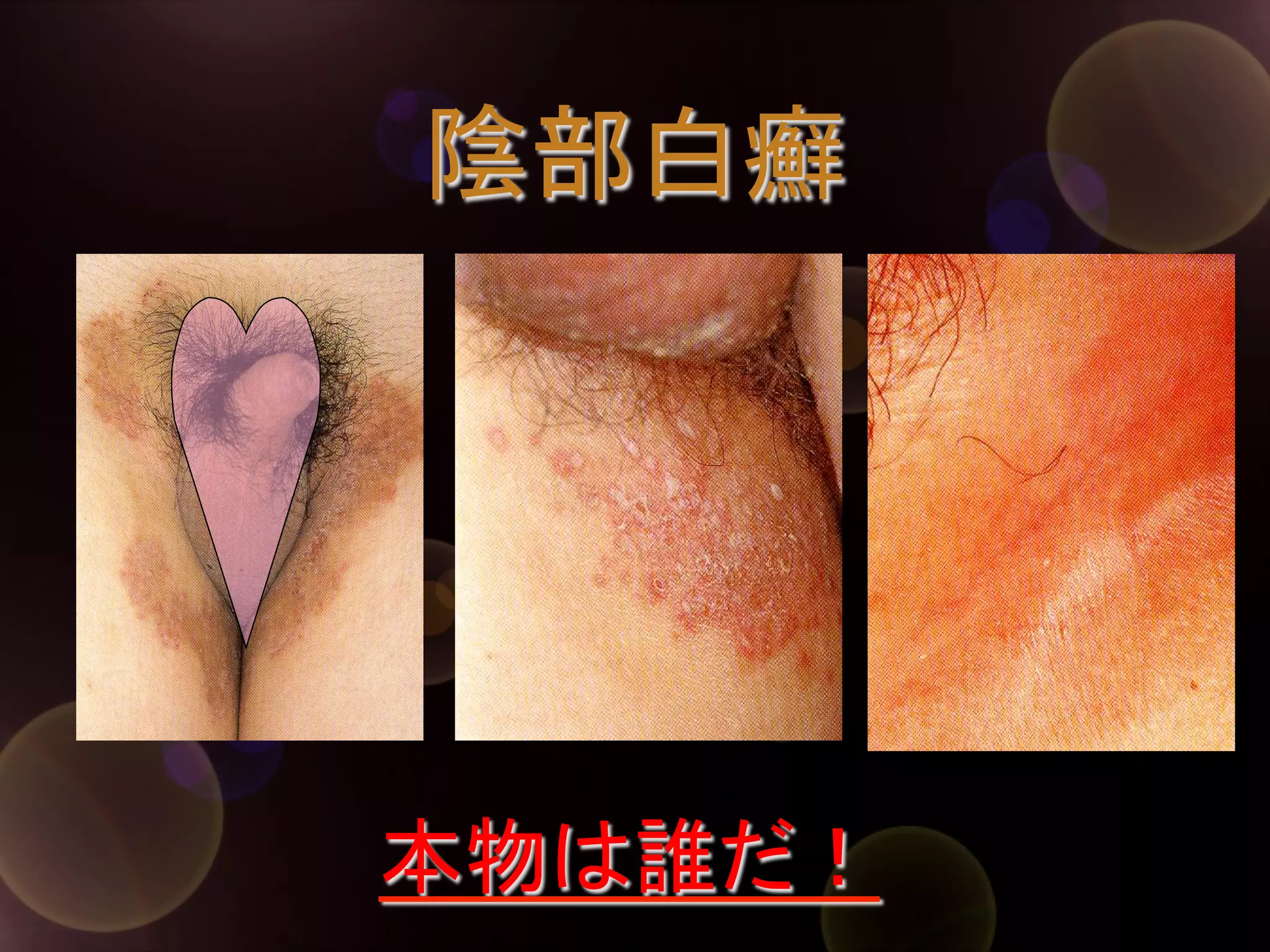 陰部白癬	

本物は誰だ！	

 