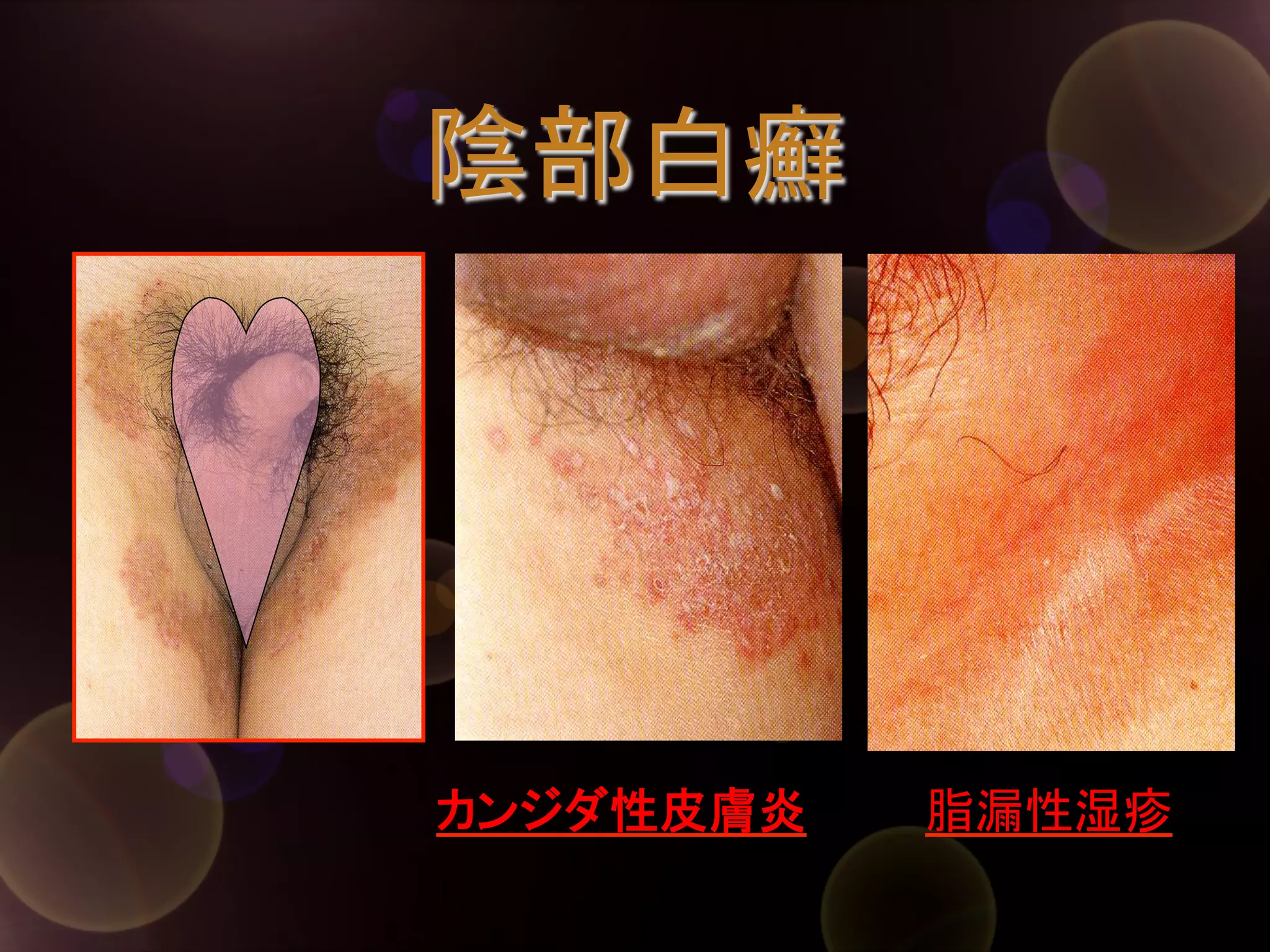 陰部白癬	

カンジダ性皮膚炎	

脂漏性湿疹	

 