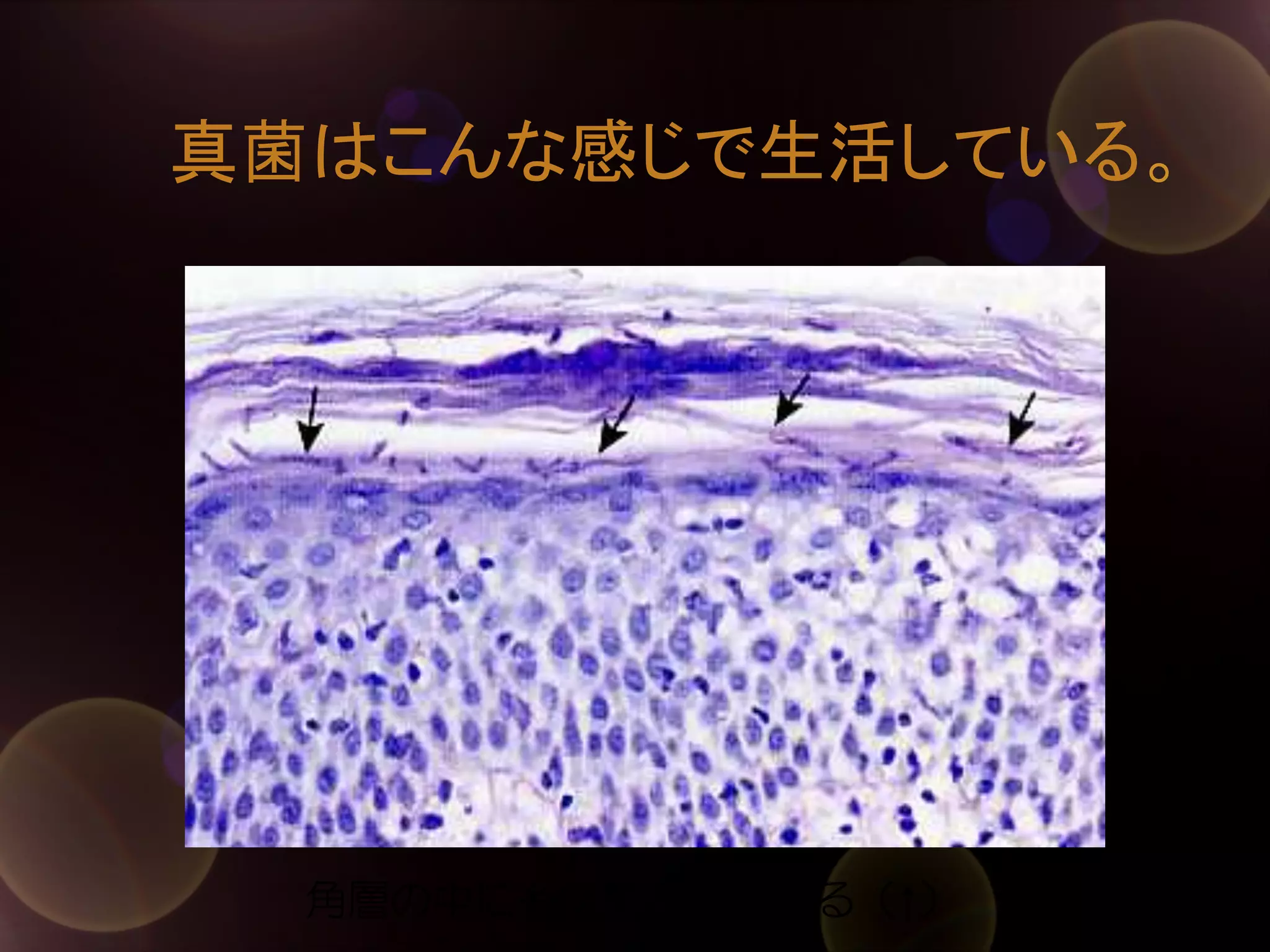 真菌はこんな感じで生活している。	

角層の中に糸状菌が見られる（↑）

 