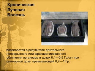 Хроническая
Лучевая
Болезнь

развивается в результате длительного
непрерывного или фракционированного
облучения организма в дозах 0,1—0,5 Гр/сут при
суммарной дозе, превышающей 0,7—1 Гр.

 