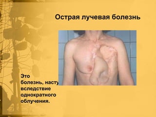 Острая лучевая болезнь

Это
болезнь, наступившая
вследствие
однократного
облучения.

 