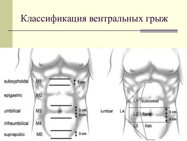 фото вентральной грыжи онлайн