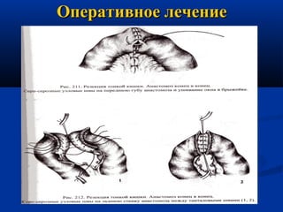 Оперативное лечение

 