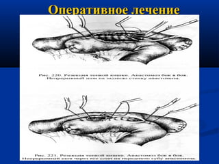 Оперативное лечение

 