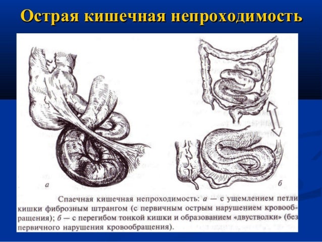 Ostraya Kishechnaya Neprohodimost