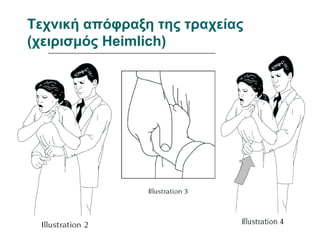 Τεχνική απόφραξη της τραχείας
(χειρισμός Heimlich)

12/18/13

 