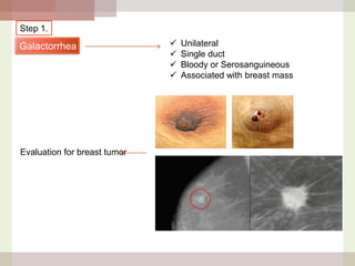 Step 1.

Galactorrhea

Evaluation for breast tumor






Unilateral
Single duct
Bloody or Serosanguineous
Associated with breast mass

 