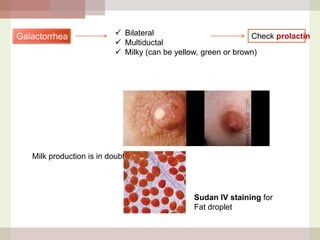 Galactorrhea

 Bilateral
Check prolactin
 Multiductal
 Milky (can be yellow, green or brown)

Milk production is in doubt

Sudan IV staining for
Fat droplet

 