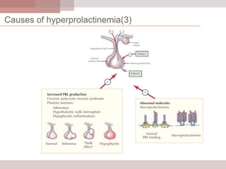 Causes of hyperprolactinemia(3)

 