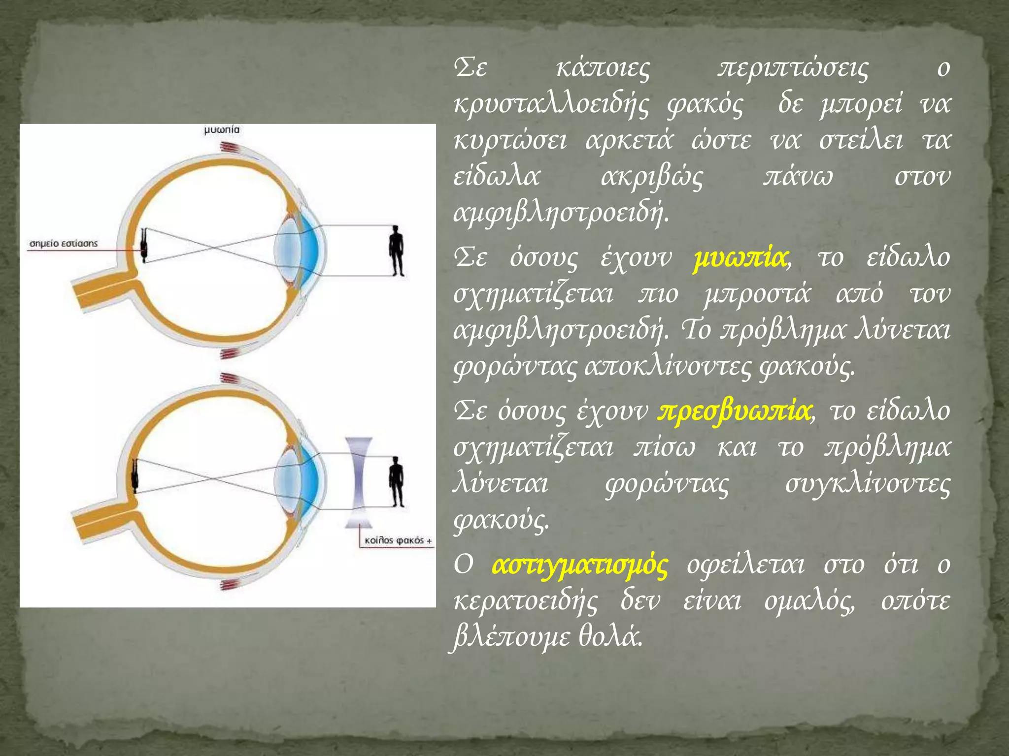 Σε
κάποιες
περιπτώσεις
ο
κρυσταλλοειδής φακός δε μπορεί να
κυρτώσει αρκετά ώστε να στείλει τα
είδωλα
ακριβώς
πάνω
στον
αμφιβληστροειδή.
Σε όσους έχουν μυωπία, το είδωλο
σχηματίζεται πιο μπροστά από τον
αμφιβληστροειδή. Το πρόβλημα λύνεται
φορώντας αποκλίνοντες φακούς.
Σε όσους έχουν πρεσβυωπία, το είδωλο
σχηματίζεται πίσω και το πρόβλημα
λύνεται
φορώντας
συγκλίνοντες
φακούς.
Ο αστιγματισμός οφείλεται στο ότι ο
κερατοειδής δεν είναι ομαλός, οπότε
βλέπουμε θολά.

 