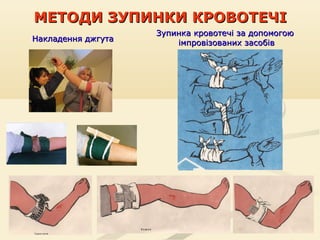 МЕТОДИ ЗУПИНКИ КРОВОТЕЧІ
Накладення джгута

Зупинка кровотечі за допомогою
імпровізованих засобів

 