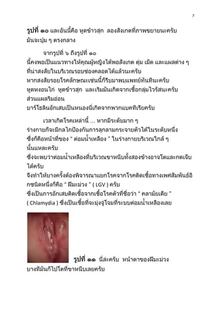 7

( LGV )
( Chlamydia )

 