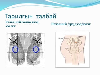 Тарилгын талбай
Өгзөгний гадна дээд
хэсэгт
Өгзөгний урд дээд хэсэг
 
