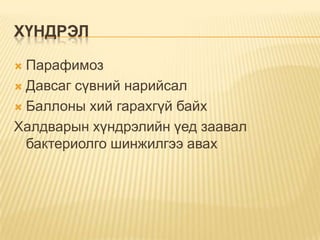 ХҮНДРЭЛ
Парафимоз
 Давсаг сүвний нарийсал
 Баллоны хий гарахгүй байх
Халдварын хүндрэлийн үед заавал
бактериолго шинжилгээ авах


 