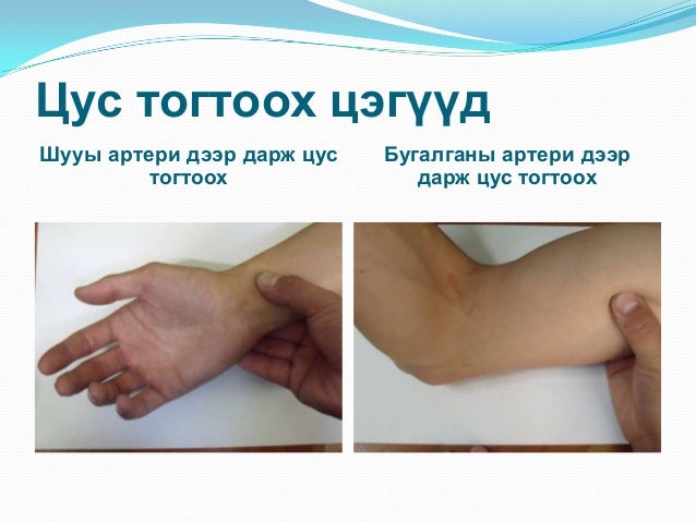 цус алдалтын үед үзүүлэх анхны тусламж