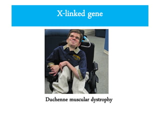 X-linked gene

Duchenne muscular dystrophy

 