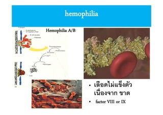 hemophilia
Hemophilia A/B

•

เลือดไม่ แข็งตัว
เนืองจาก ขาด

• factor VIII or IX

 