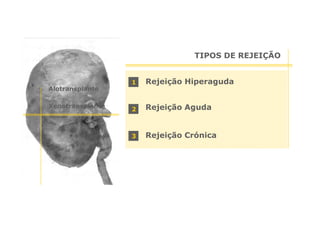 TIPOS DE REJEIÇÃO

1

Rejeição Hiperaguda

2

Rejeição Aguda

3

Rejeição Crónica

Alotransplante
Xenotransplante

 