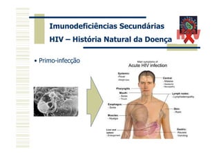 Imunodeficiências Secundárias
HIV – História Natural da Doença
• Primo-infecção

 