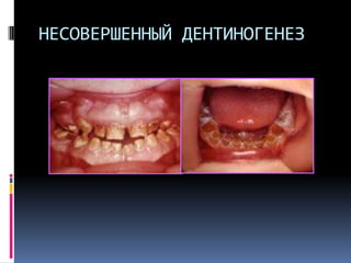 НЕСОВЕРШЕННЫЙ ДЕНТИНОГЕНЕЗ

 