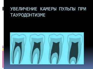УВЕЛИЧЕНИЕ КАМЕРЫ ПУЛЬПЫ ПРИ
ТАУРОДОНТИЗМЕ

 