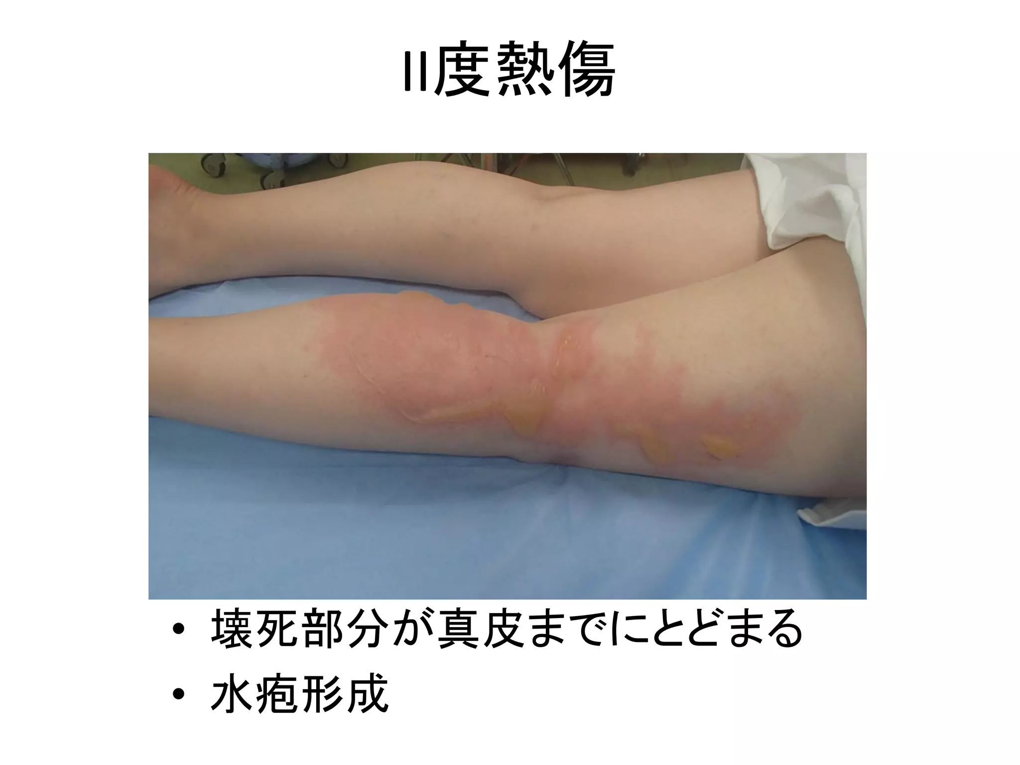 熱傷勉強会（看護師向け） | PDF | Physical Therapy | Wellness