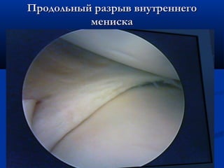 Продольный разрыв внутреннегоПродольный разрыв внутреннего
менискамениска
 