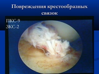 Повреждения крестообразныхПовреждения крестообразных
связоксвязок
ПКС-9
ЗКС-2
 