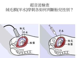 超音波檢查
絨毛膜(羊水)穿刺各如何判斷胎兒性別？
 