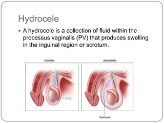 Hydrocele
 A hydrocele is a collection of fluid within the
processus vaginalis (PV) that produces swelling
in the inguinal region or scrotum.
 