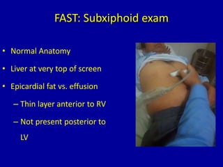 FAST: Subxiphoid exam
• Normal Anatomy
• Liver at very top of screen
• Epicardial fat vs. effusion
– Thin layer anterior to RV
– Not present posterior to
LV
 