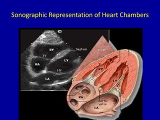 Sonographic Representation of Heart Chambers
 