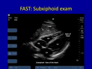 FAST: Subxiphoid exam
 