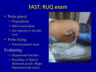 FAST: RUQ exam
• Probe placed
– Perpendicular
– Mid-coronal plane
– Just superior to the iliac
crest
• Probe facing
– Toward patient’s head
Evaluating
– Hepatorenal interface
– Possibility of fluid in
Morison’s pouch ( Right
Supramesocolic space)
 
