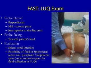 FAST: LUQ Exam
• Probe placed
– Perpendicular
– Mid - coronal plane
– Just superior to the iliac crest
• Probe facing
– Towards patient’s head
• Evaluating
– Spleno-renal interface
– Possibility of fluid in Splenorenal
recess and presplenic /subphrenic
space( most common space for
fluid collection in LUQ)
 