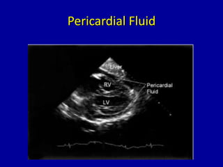 Pericardial Fluid
 