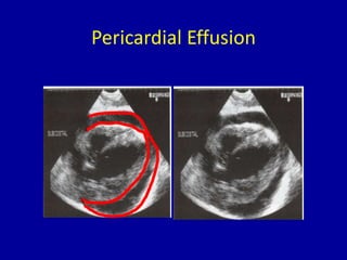 Pericardial Effusion
 