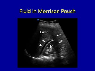 Fluid in Morrison Pouch
 