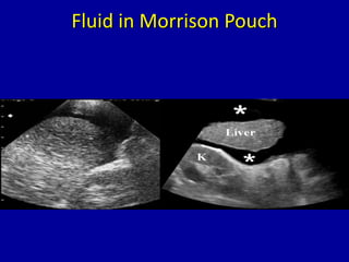 Fluid in Morrison Pouch
L
K
FF
 
