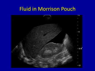 Fluid in Morrison Pouch
 