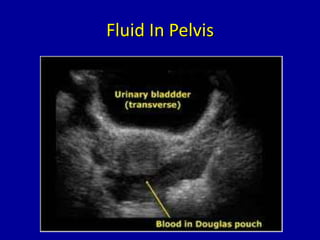 Fluid In Pelvis
 