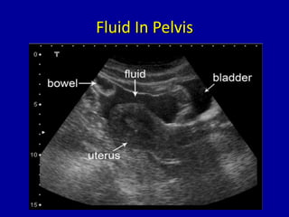 Fluid In Pelvis
 