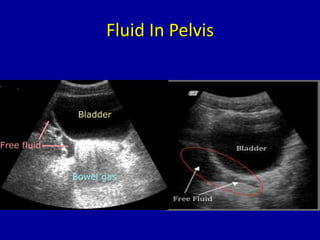 Fluid In Pelvis
 
