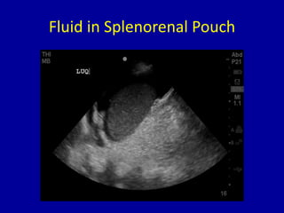 Fluid in Splenorenal Pouch
 
