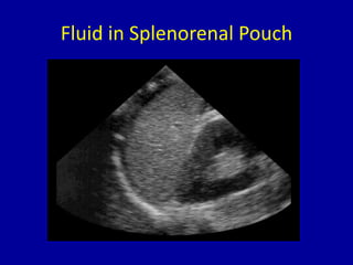 Fluid in Splenorenal Pouch
 